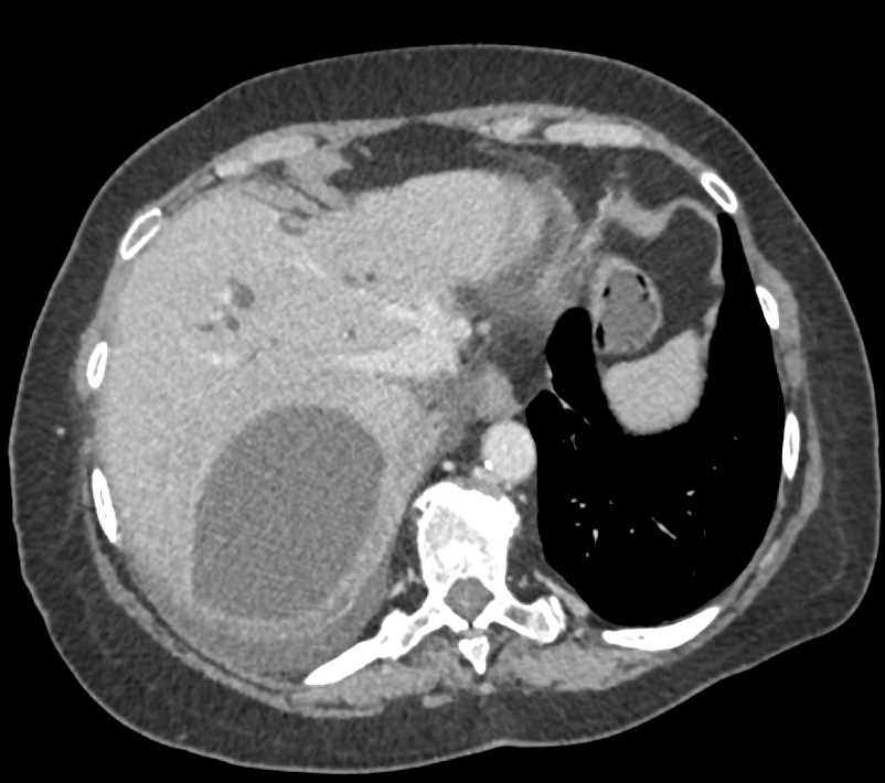Biloma - CTisus CT Scan