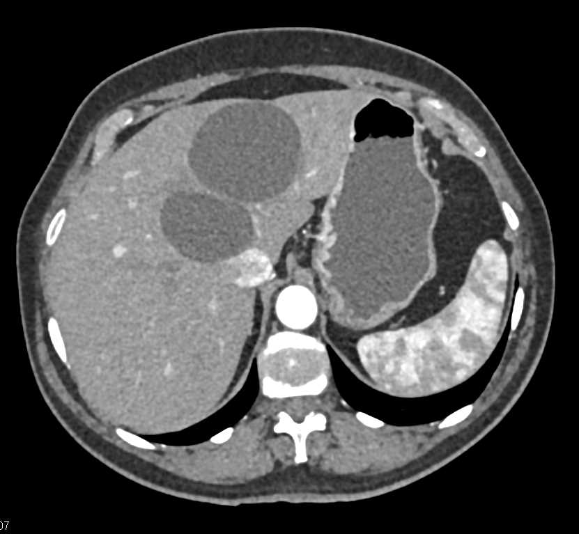 Simple Liver Cysts - CTisus CT Scan