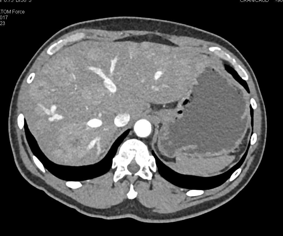 Metastatic Carcinoid Tumor to the Liver - CTisus CT Scan