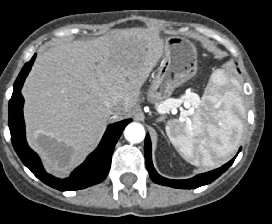 Cholangiocarcinoma Liver - CTisus CT Scan
