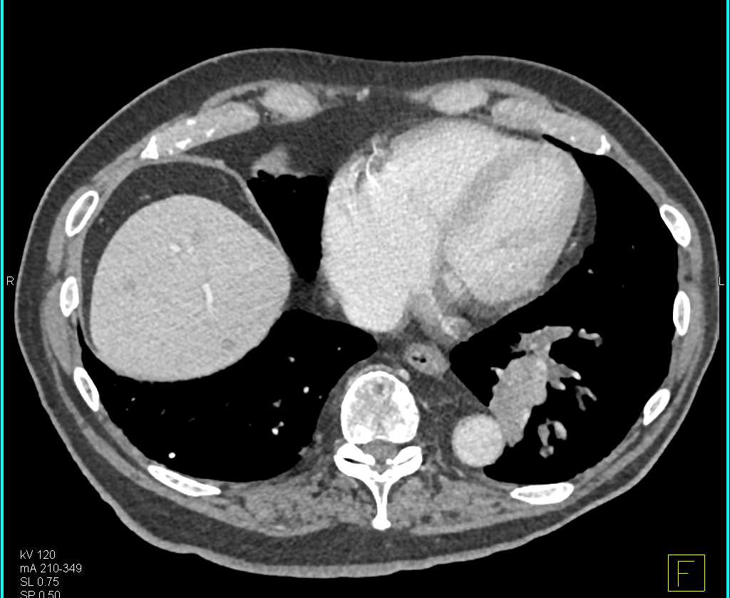 Lung Cancer Metastatic to the Liver - CTisus CT Scan