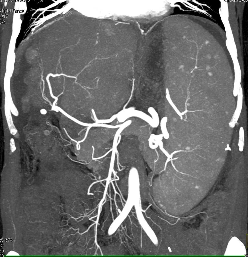Cirrhosis with Multifocal Hepatocellular Carcinoma (Hepatoma) - CTisus CT Scan
