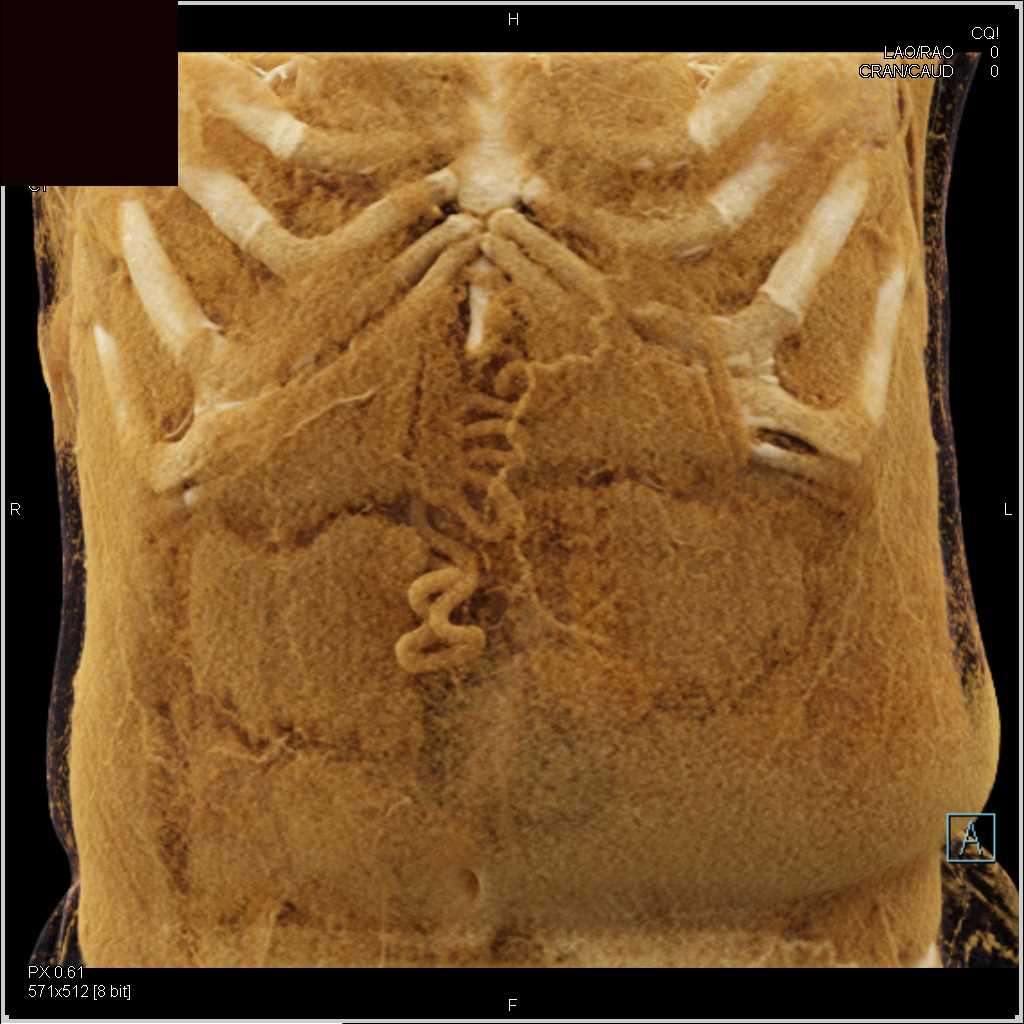 Cirrhosis with Multifocal Hepatocellular Carcinoma (Hepatoma) and Splenomegaly - CTisus CT Scan