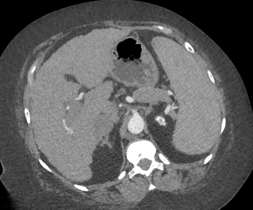 Cirrhosis and Portal Hypertension with End Stage Renal Disease (ESRD) - CTisus CT Scan