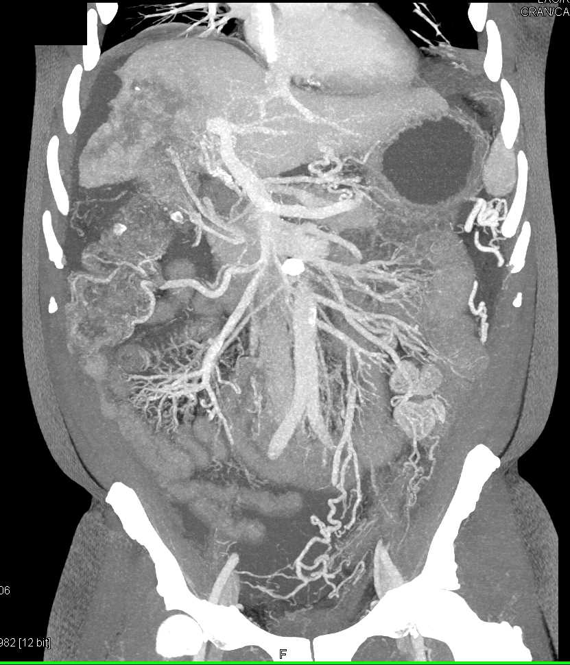 Hepatocellular Carcinoma (Hepatoma) - CTisus CT Scan