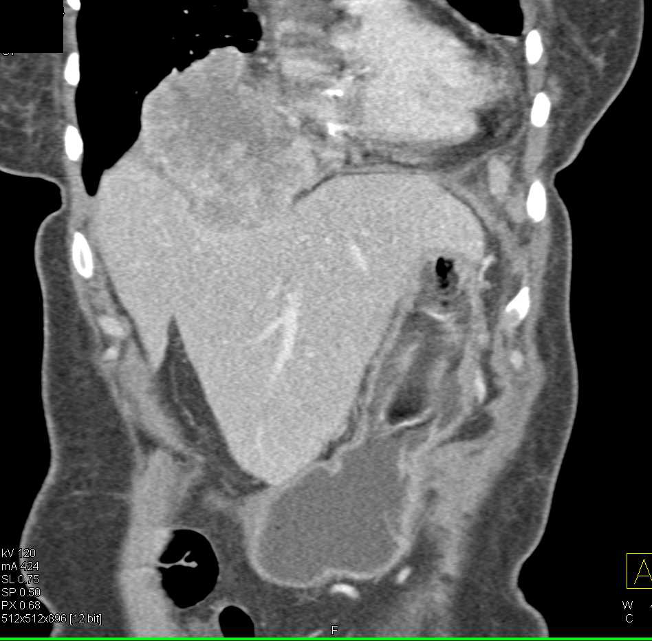 Hepatocellular Carcinoma (Hepatoma) Invades the Diaphragm - CTisus CT Scan