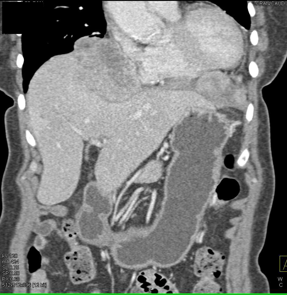 Hepatoma Invades the Diaphragm - CTisus CT Scan