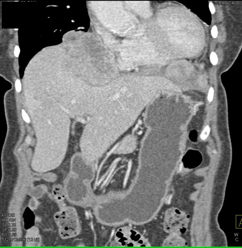 Hepatocellular Carcinoma (Hepatoma) Invades the Diaphragm - CTisus CT Scan