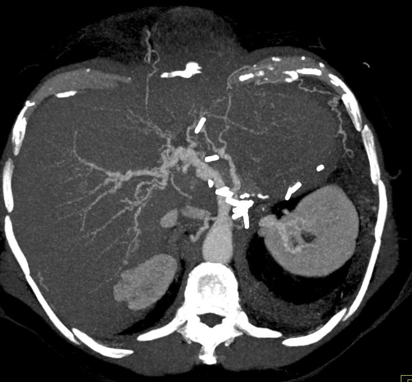 Cirrhosis with Irregular Hepatic Artery - CTisus CT Scan