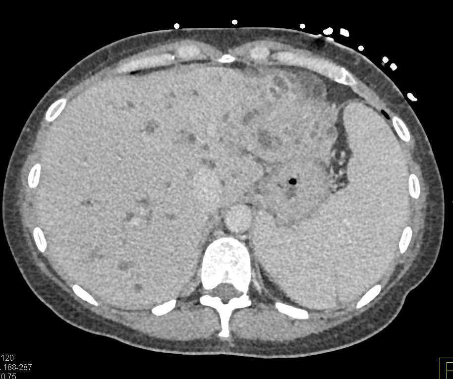 Central Cholangiocarcinoma with Tumor Spread - CTisus CT Scan
