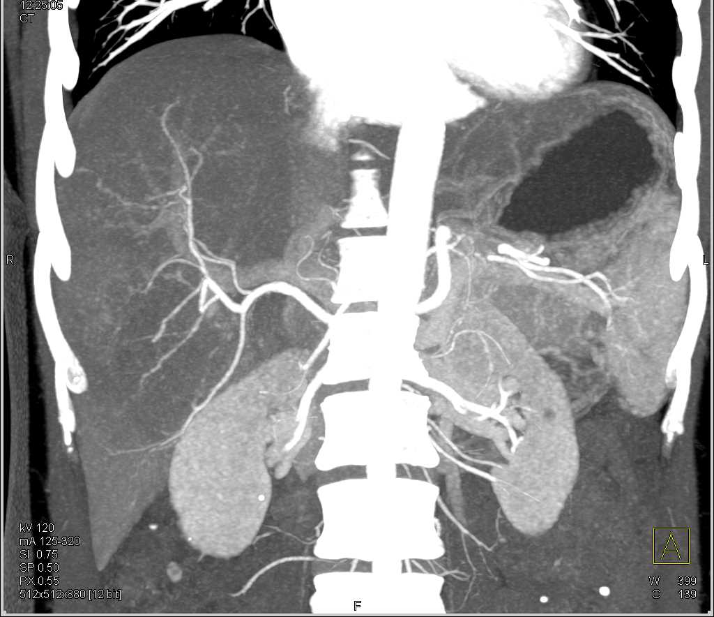 CTA Liver with a Cholangiocarcinoma - CTisus CT Scan