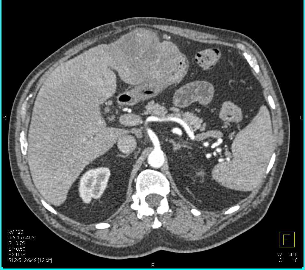 Hepatocellular Carcinoma (Hepatoma) Invades the Stomach - CTisus CT Scan