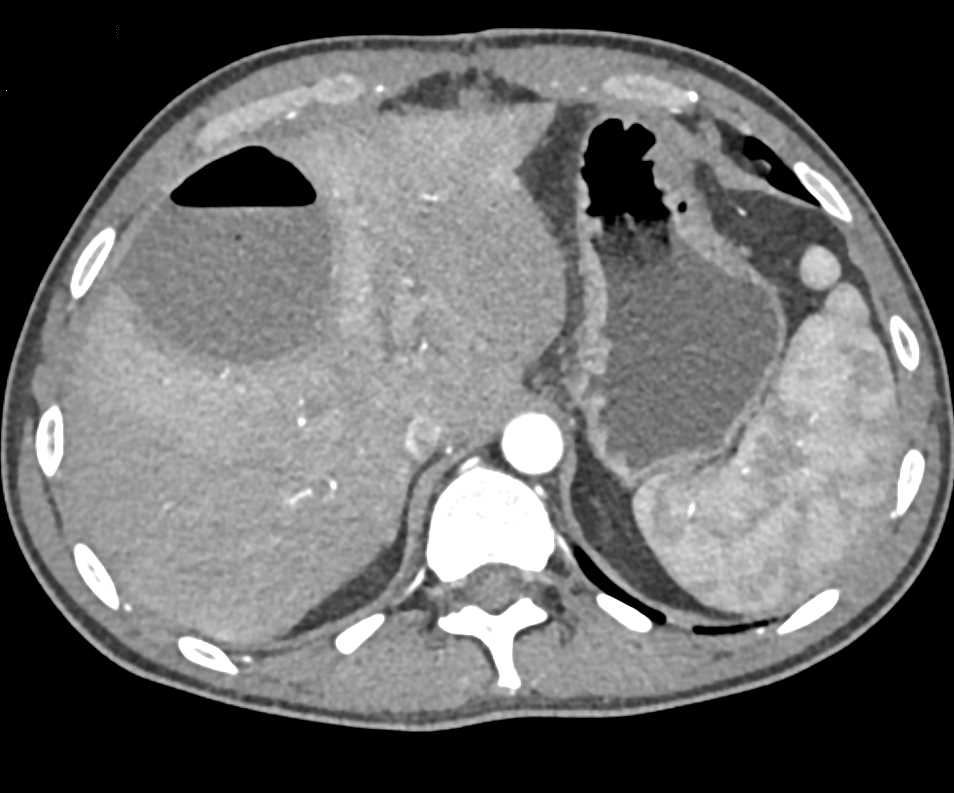 Liver Abscess - CTisus CT Scan