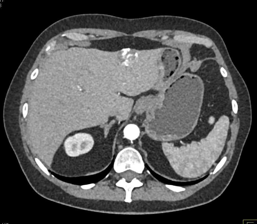 Hemangioma Liver - CTisus CT Scan