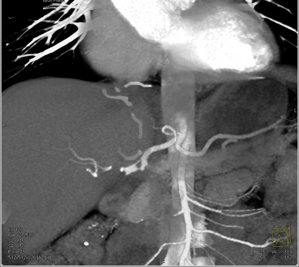 Stenosis of the Hepatic Artery in Liver Transplant Patient - CTisus CT Scan