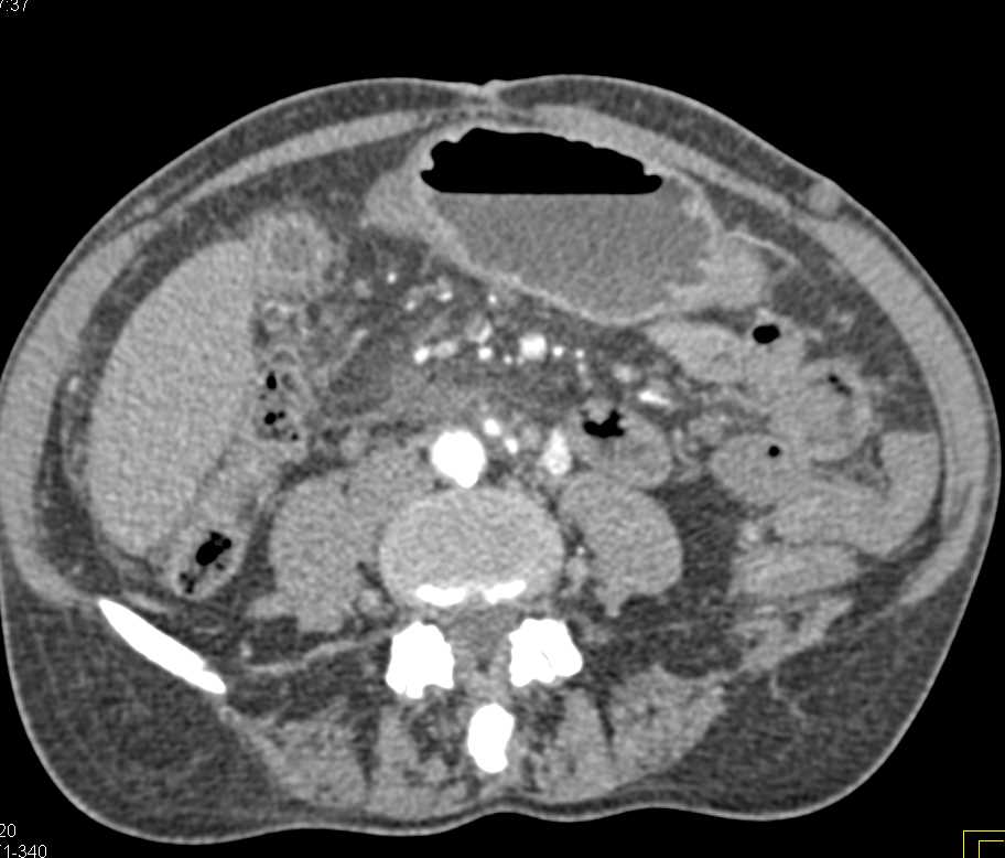 Acute Cholecystitis - CTisus CT Scan