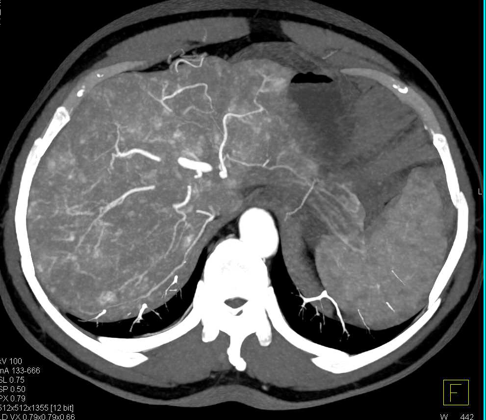 Multifocal Hepatocellular Carcinoma (Hepatoma) in the Liver - CTisus CT Scan