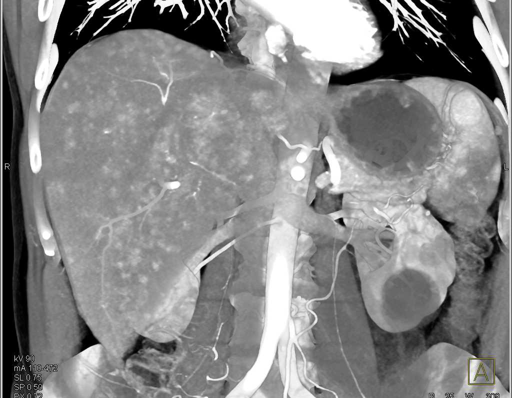 Vascular Liver Metastases from a Neuroendocrine Tumor - CTisus CT Scan