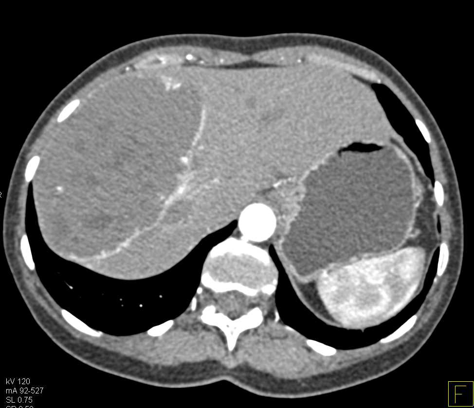 Giant Cavernous Hemangioma of the Liver - CTisus CT Scan