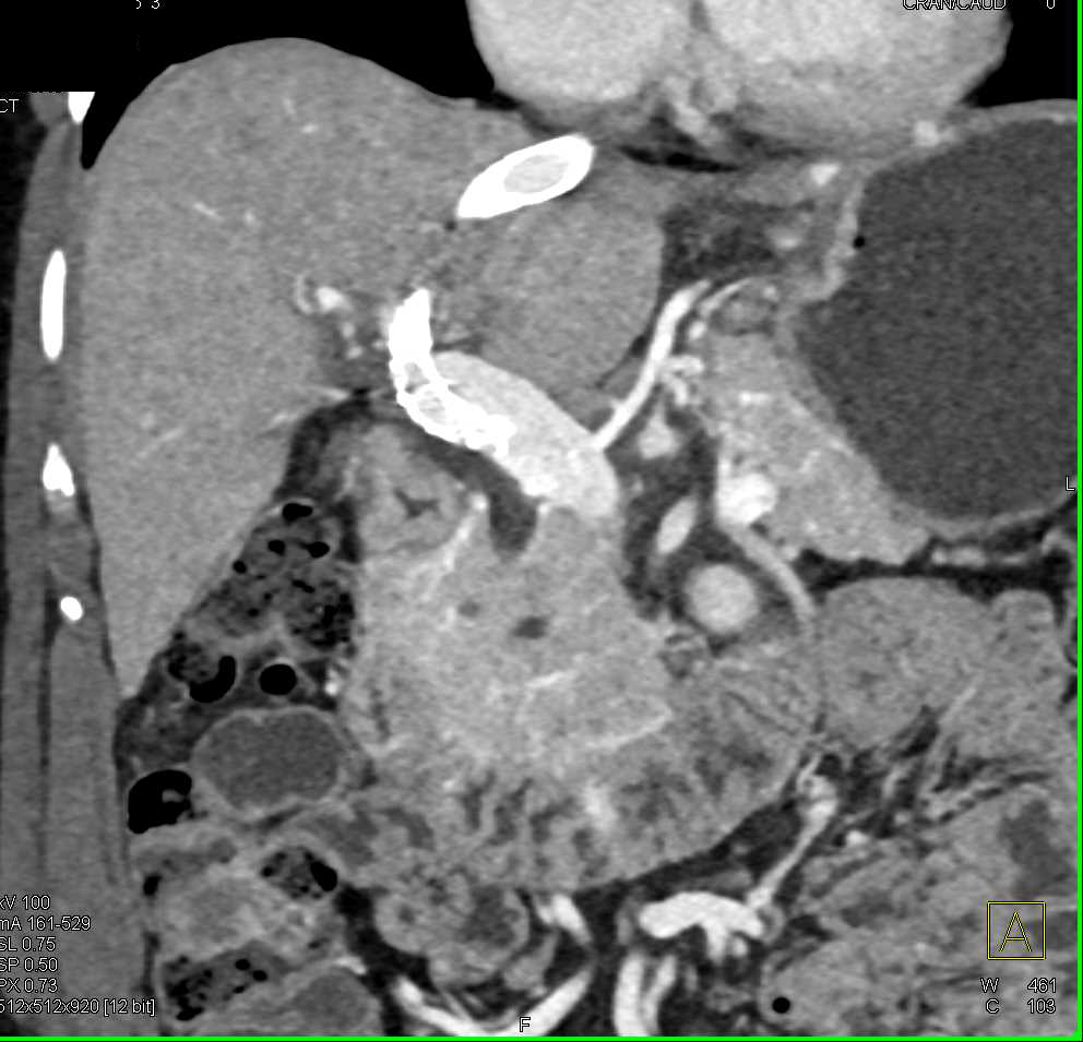 Transjugular Intrahepatic Portosystemic Shunt (TIPS) Catheter - CTisus CT Scan