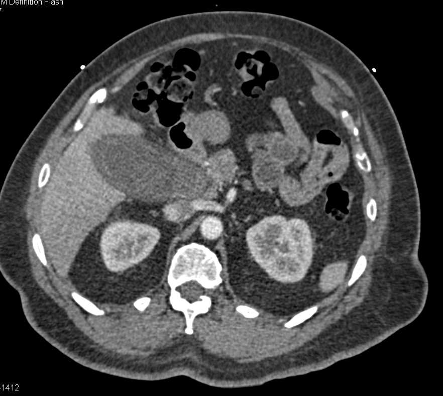 Acute Cholecystitis and Impacted Stone - CTisus CT Scan