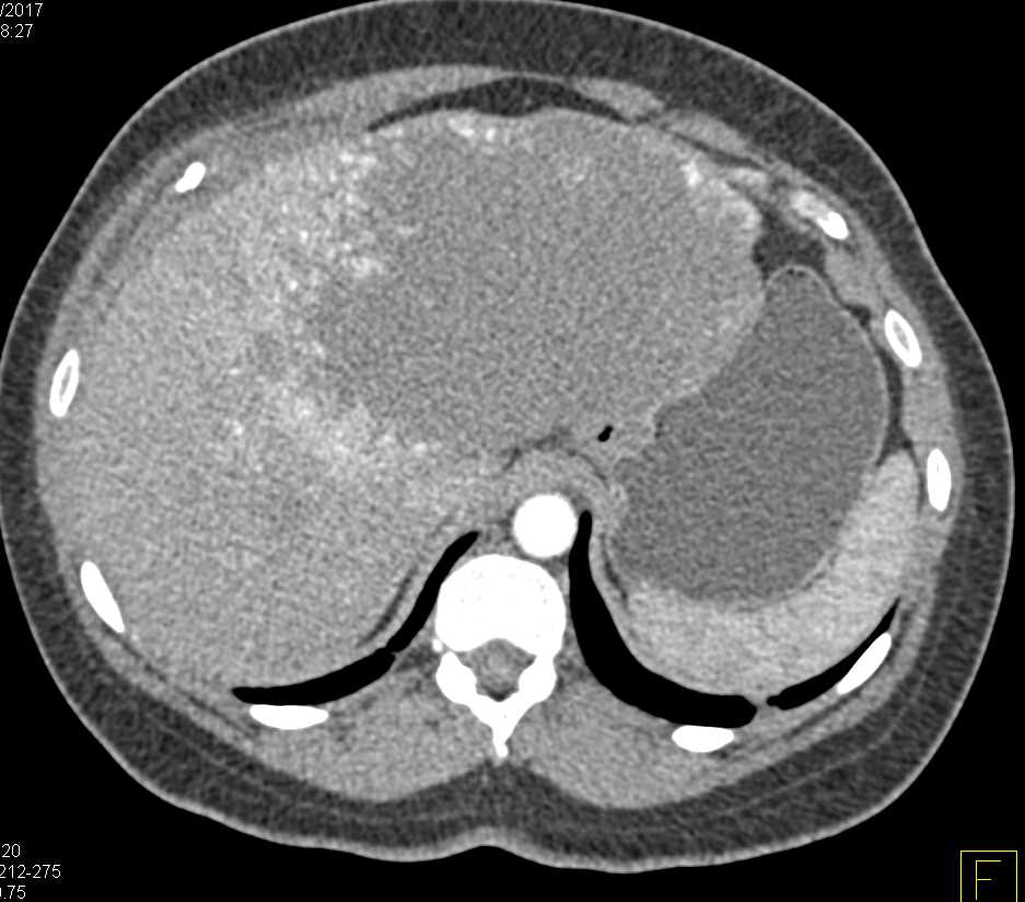 Giant Cavernous hemangioma of the Liver - CTisus CT Scan