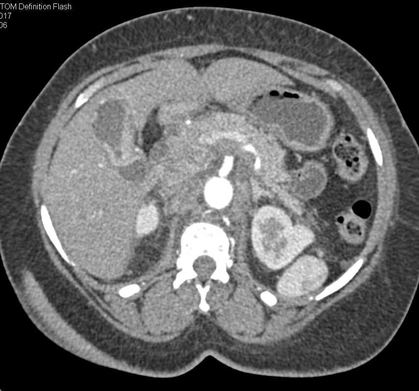 Gallbladder Cancer with Adenopathy and Liver and Bone Metastases - CTisus CT Scan
