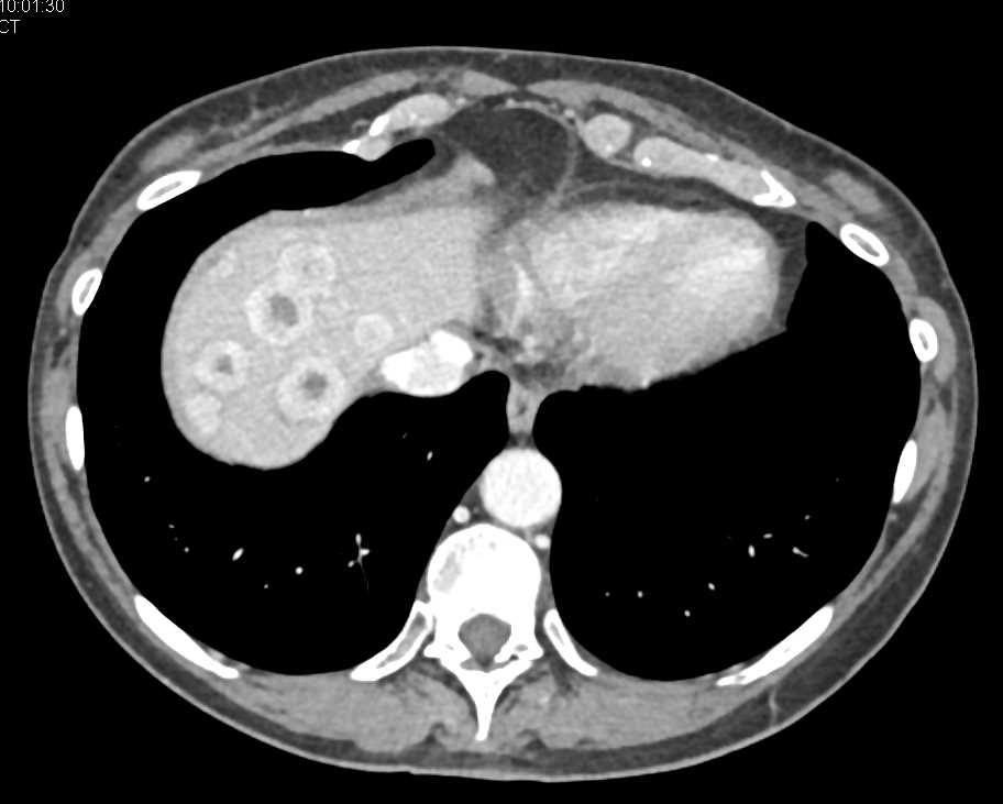 Metastatic Carcinoid Tumor to the Liver - CTisus CT Scan