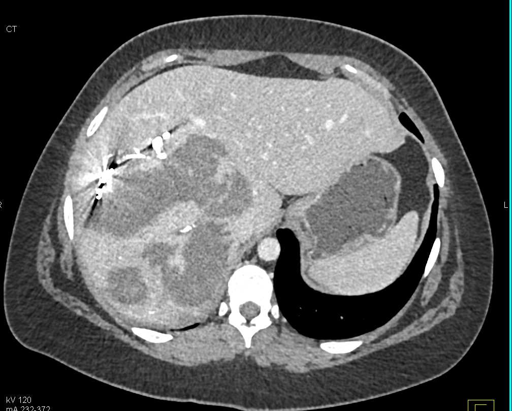 Hepatic Lacerations - CTisus CT Scan