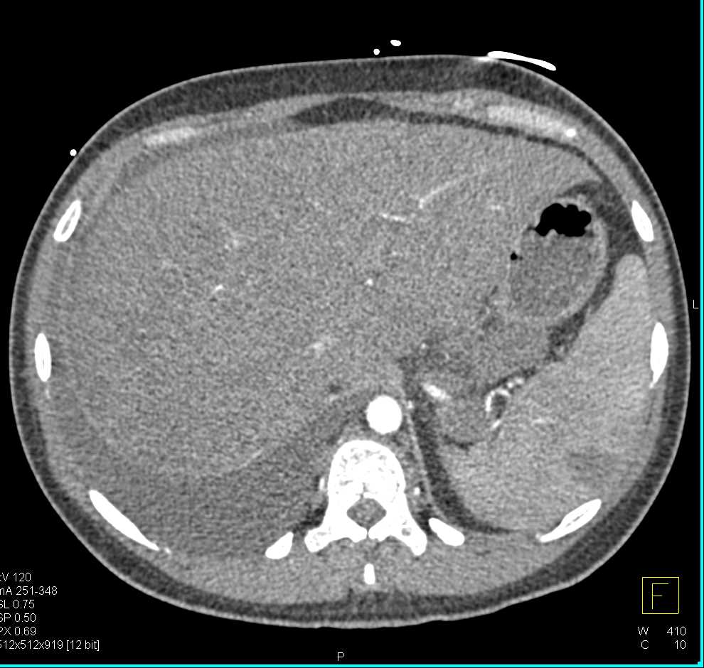 Lymphoma Involves the Liver and Spleen - CTisus CT Scan