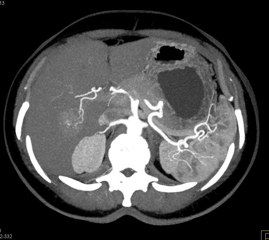 Focal Nodular Hyperplasia (FNH) Liver - CTisus CT Scan