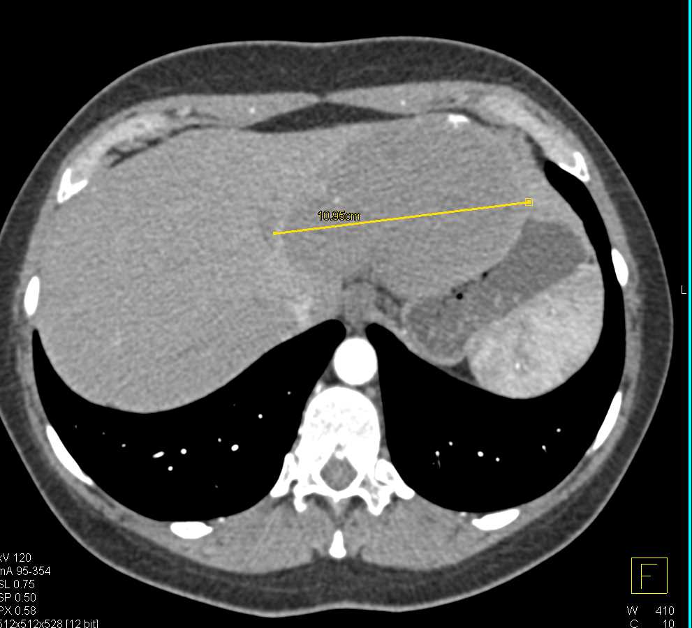 Hemangiomas and Focal Nodular Hyperplasia (FNH) Liver - CTisus CT Scan