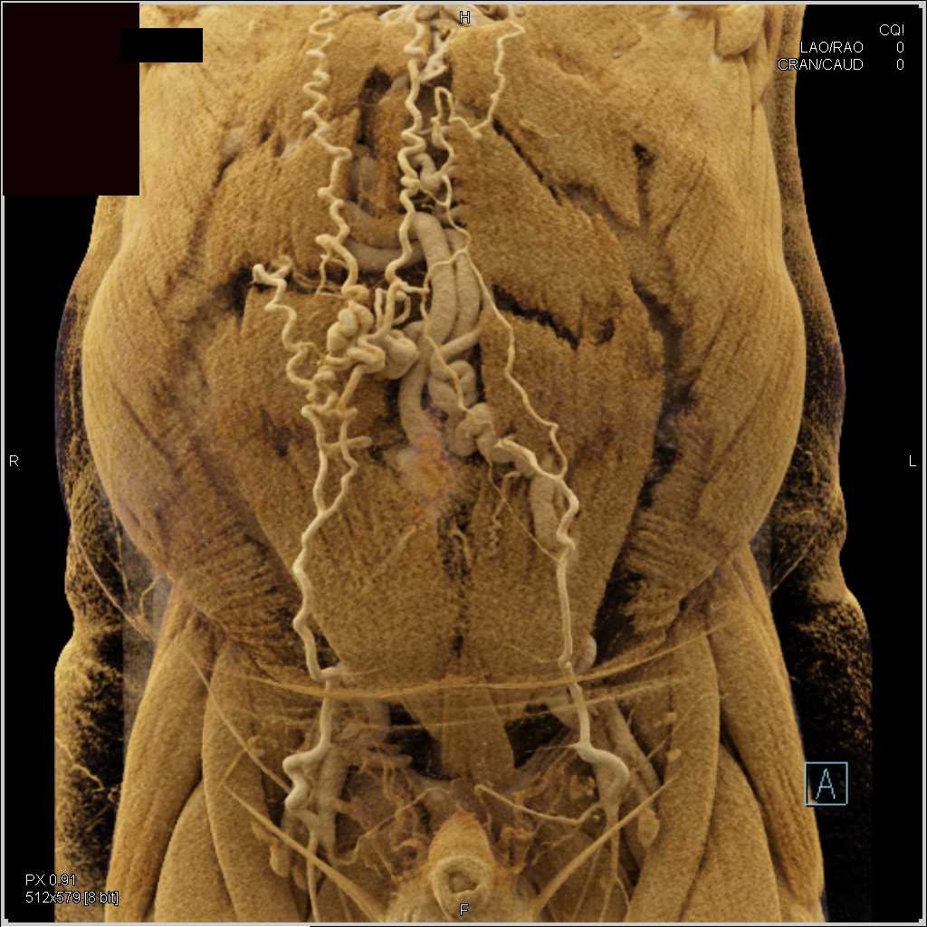Cirrhosis with Extensive Collaterals in the Abdominal Wall - CTisus CT Scan