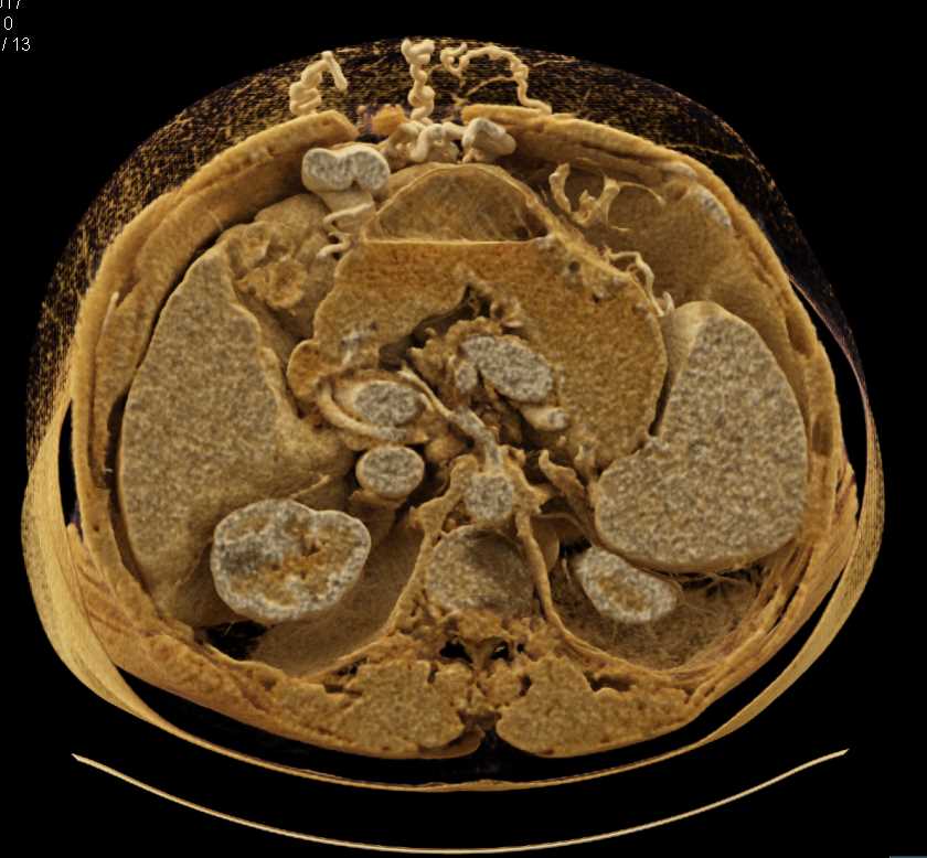 Cirrhosis with Extensive Collaterals in the Abdominal Wall - CTisus CT Scan