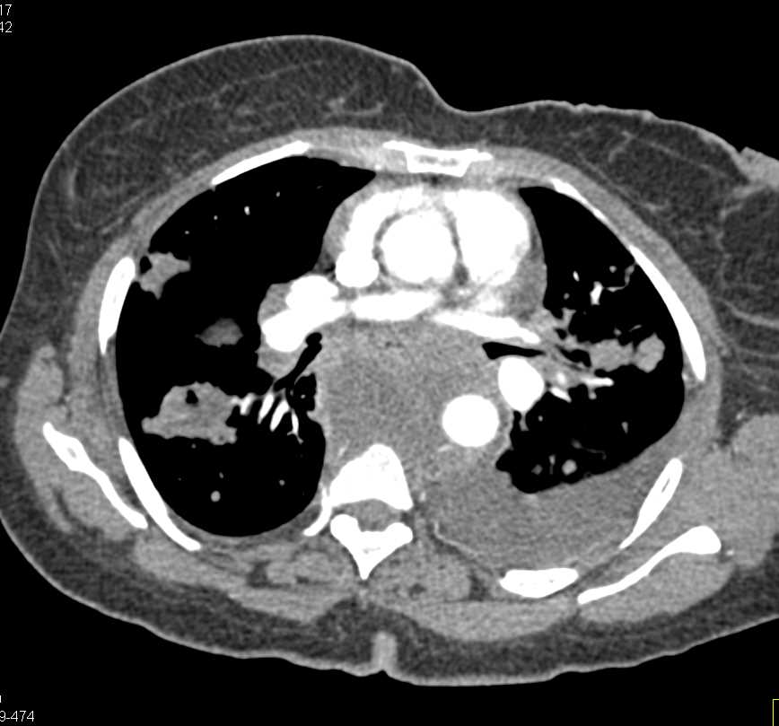 Neuroendocrine Tumor with Extensive Metastases - CTisus CT Scan