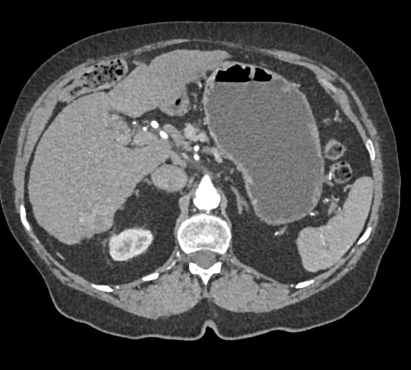 2cm Hepatocellular Carcinoma (Hepatoma) Right Lobe of the Liver - CTisus CT Scan