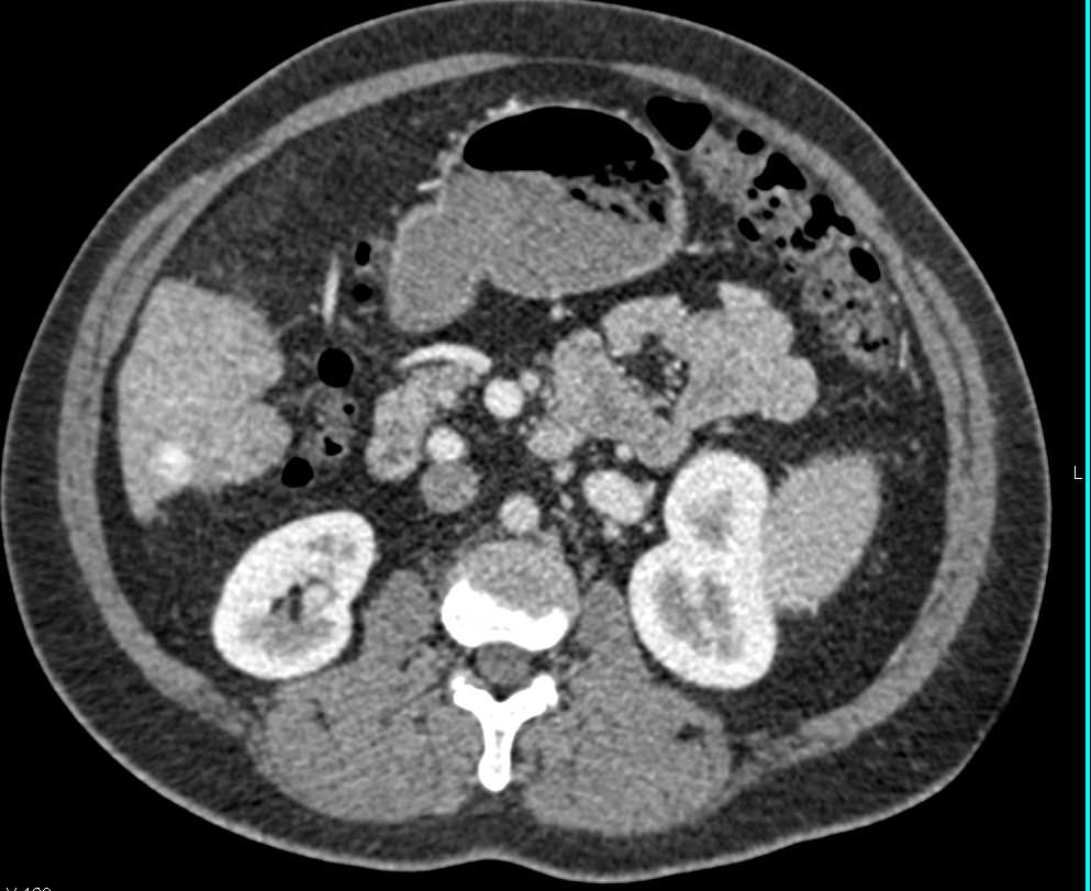 Regenerative Nodule in a Cirrhotic Liver - CTisus CT Scan