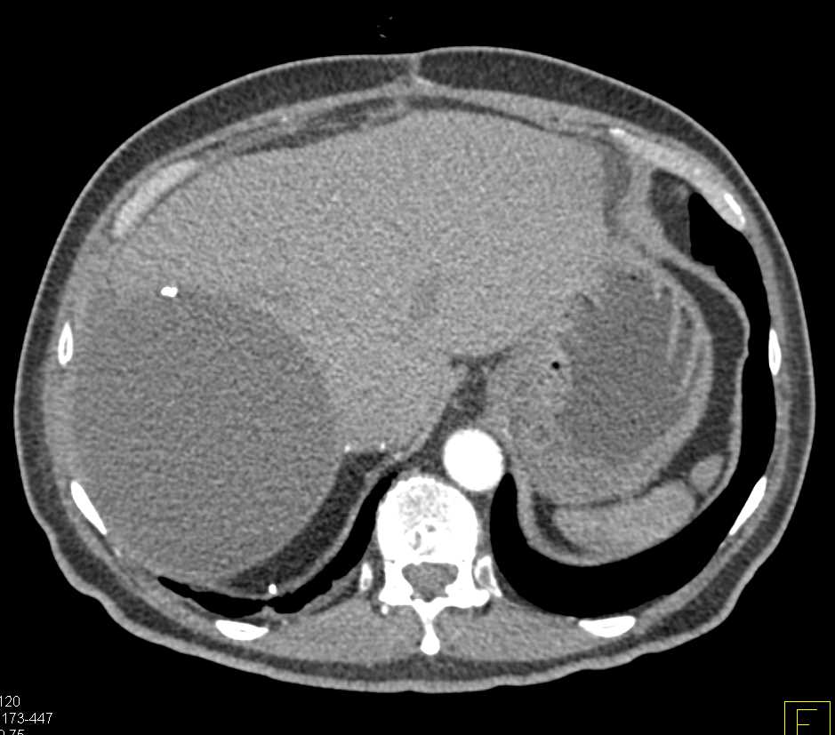 Hepatic Cyst - CTisus CT Scan
