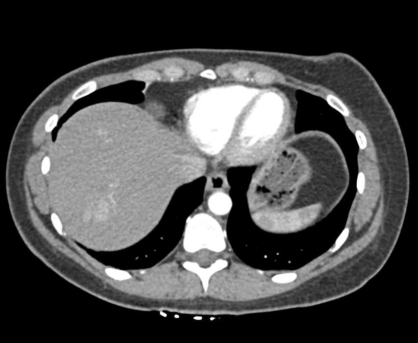 Hepatic Hemangiomas - CTisus CT Scan
