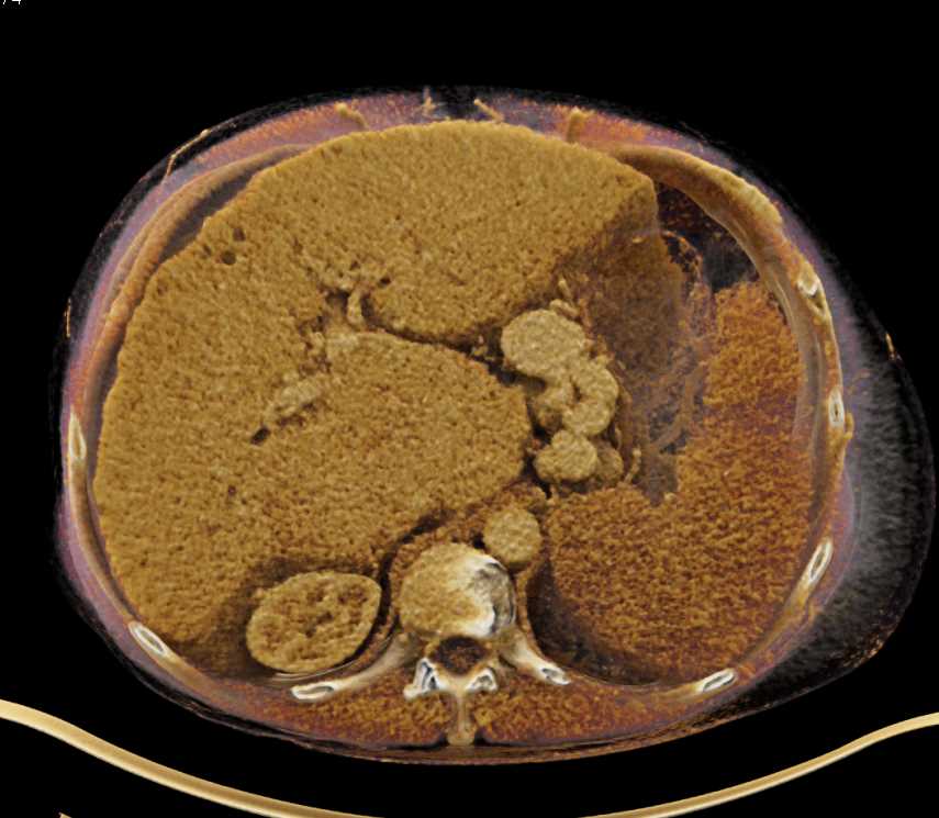 Cirrhosis with Portal Hypertension - CTisus CT Scan