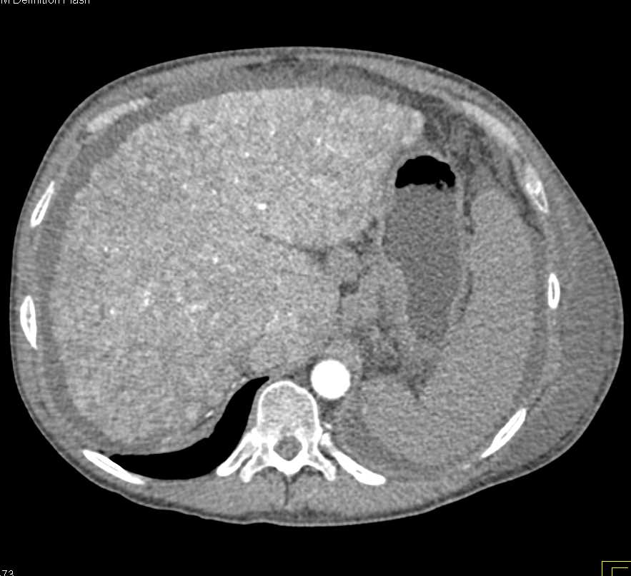 Cirrhosis with Varices and Portal Hypertension - CTisus CT Scan