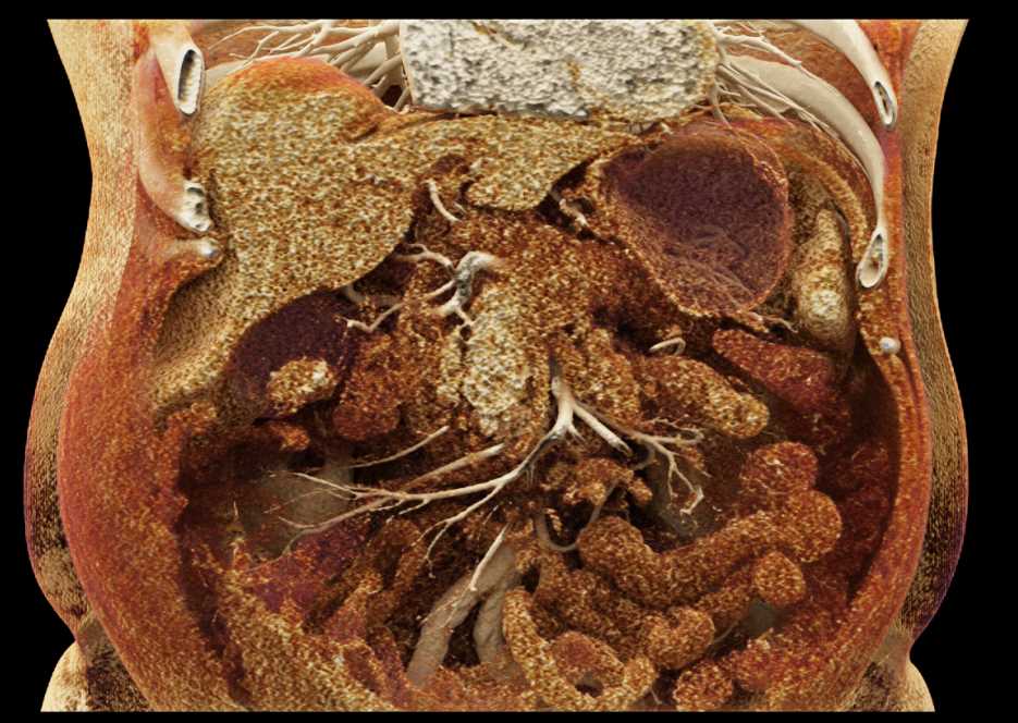 Melanoma with Extensive Nodes and Mets to the Gallbladder - CTisus CT Scan