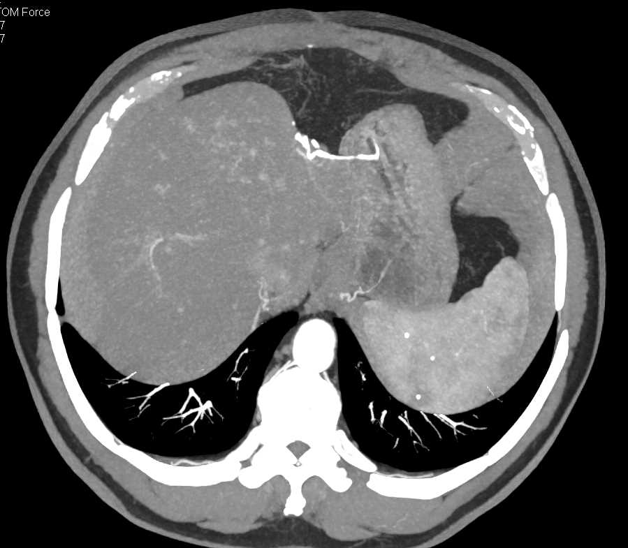 Metastatic Neuroendocrine Tumor Liver - CTisus CT Scan