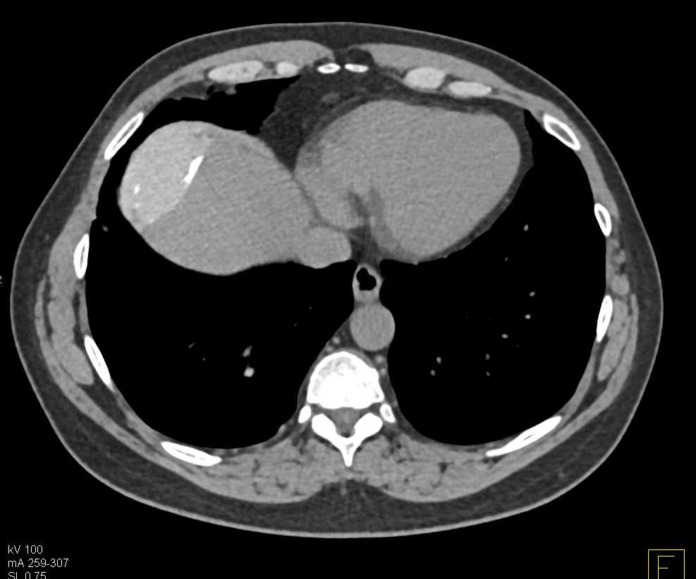High Density Hepatic Cyst - CTisus CT Scan