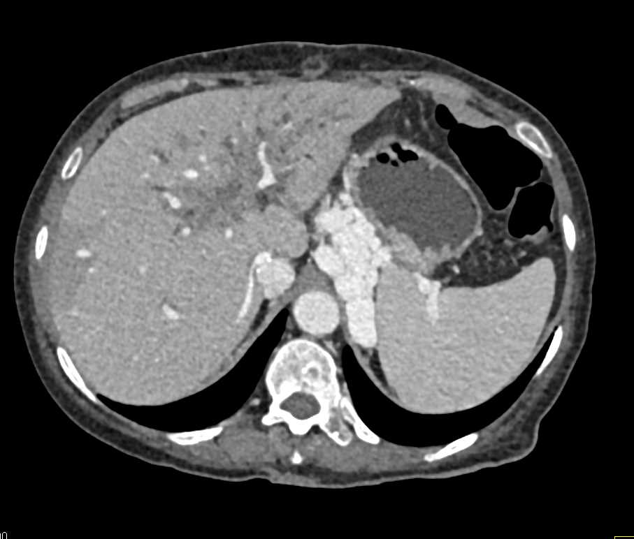 Cholangiocarcinoma with Huge Varices - CTisus CT Scan