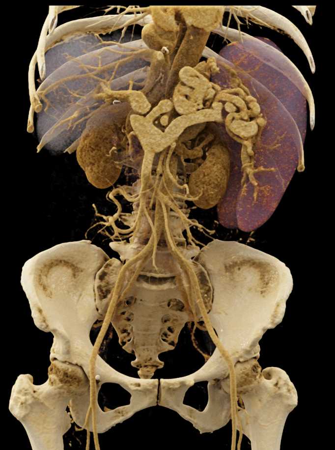 Portal Hypertension with Large Varices - CTisus CT Scan
