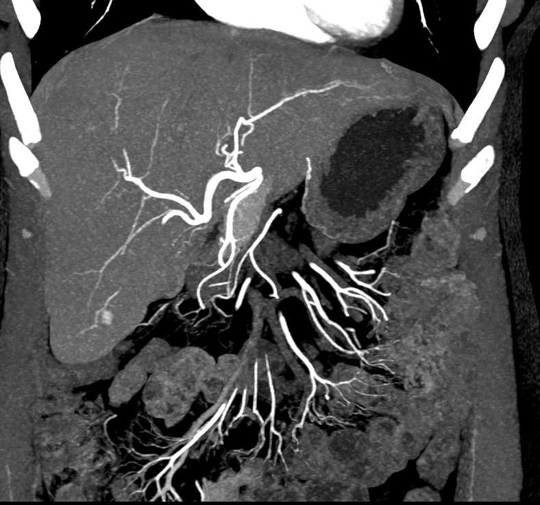 Vascular Liver Metastases - CTisus CT Scan