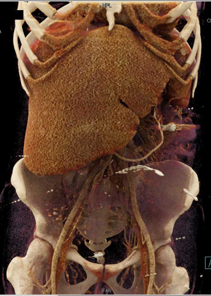 Texture Mapping of the Liver - CTisus CT Scan