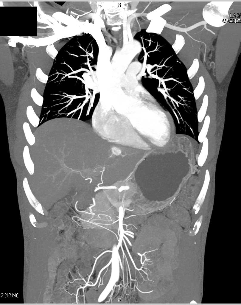 Hepatic Hemangioma - CTisus CT Scan