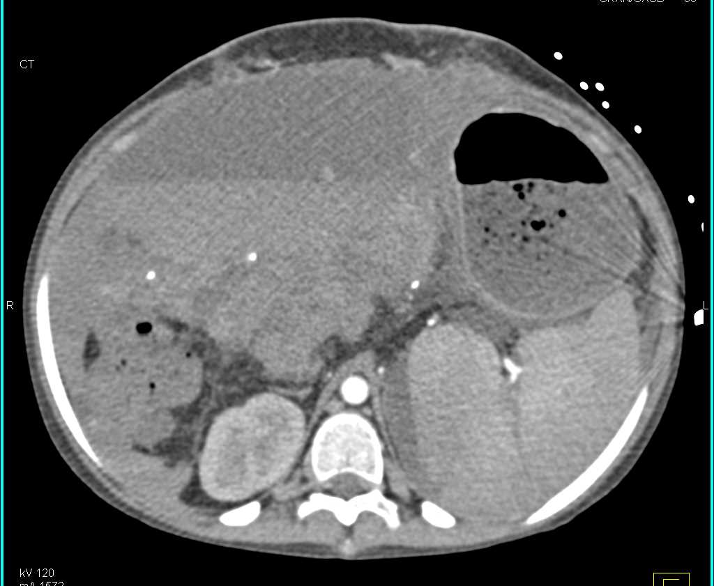 Active Bleed Adjacent to the Liver - CTisus CT Scan